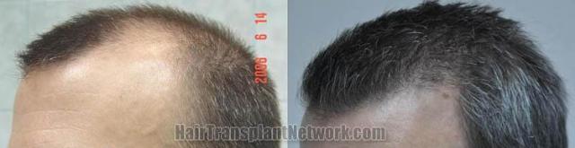 Hair transplantation surgery before and after images