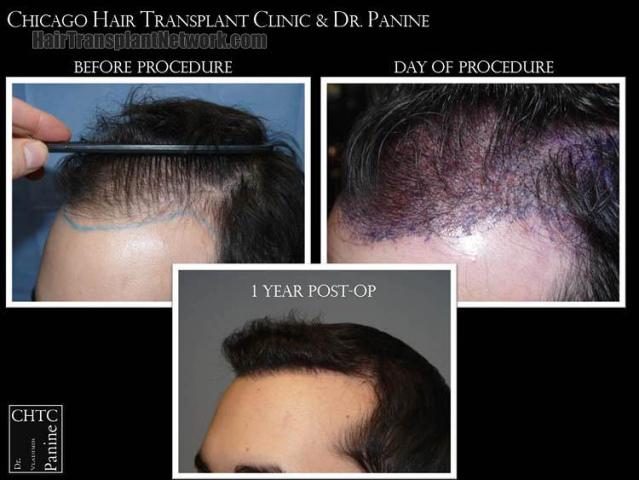 Hair restoration procedure before and after pictures