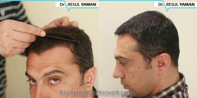 Hair transplantation surgery before and after pictures