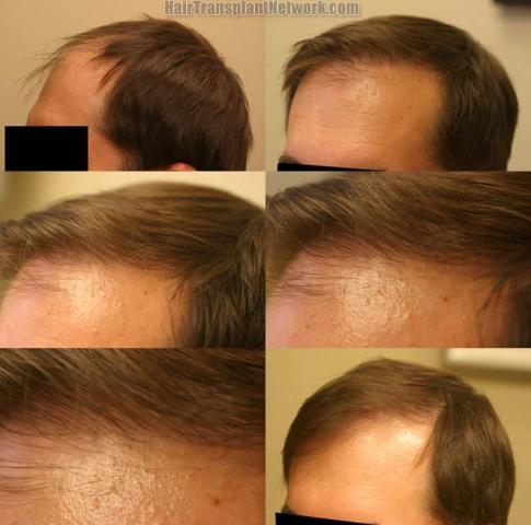 Hair transplantation surgery before and after photos