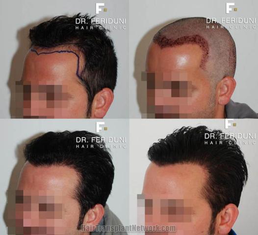 Hair restoration surgery before and after photos