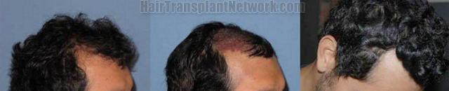 Right side hair transplant before and after result pictures