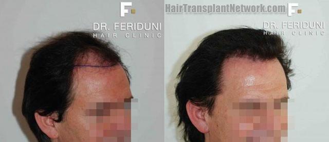 Photos showing before and after hair restoration