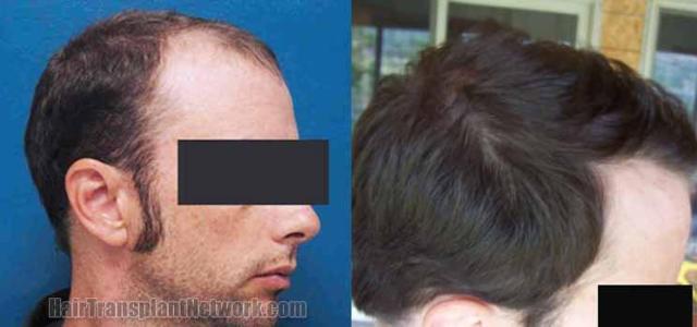 Hair restoration procedure before and after pictures