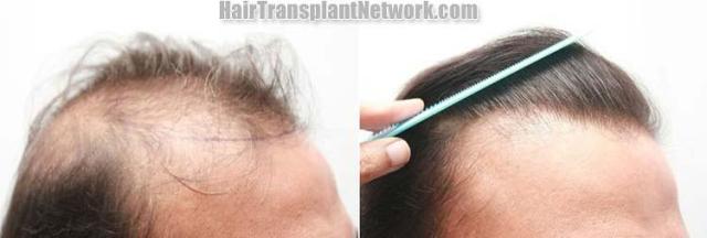 Hair restoration procedure before and after results