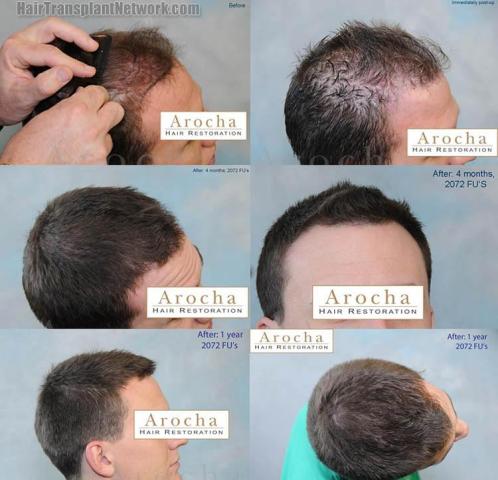 Before and after hair transplantation result photographs