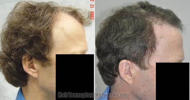 Hair transplantation surgery before and after photos