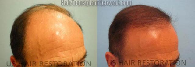 Hair transplantation surgery before and after photos