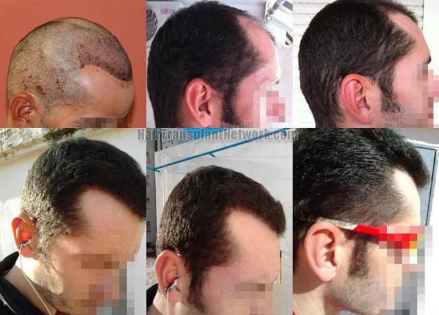 Hair transplantation surgery before and after images