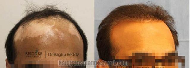 Hair transplantation surgery before and after photos