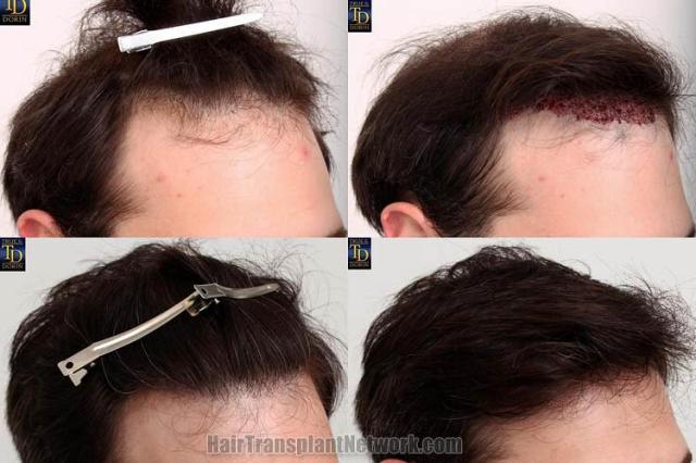 Hair transplantation surgery before and after photos