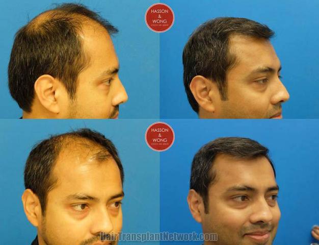 Hair transplantation surgery before and after images