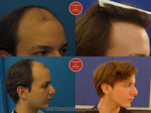 Hair transplantation surgery before and after photos