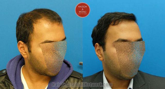 Hair transplantation surgery before and after images