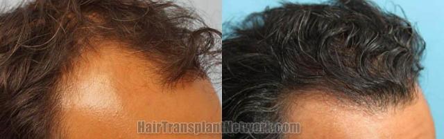 Hair transplantation surgery before and after images