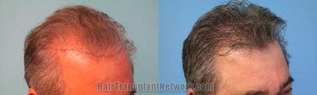 Hair transplantation surgery before and after pictures