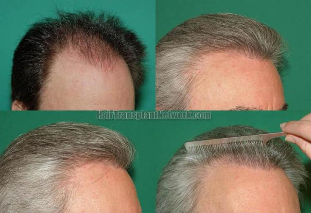 Hair transplantation surgery before and after images