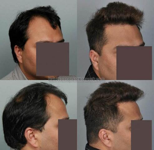 Hair transplantation surgery before and after pictures