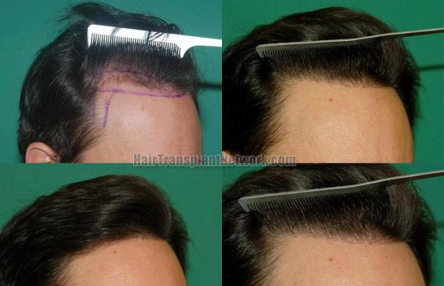 Hair transplantation surgery before and after images