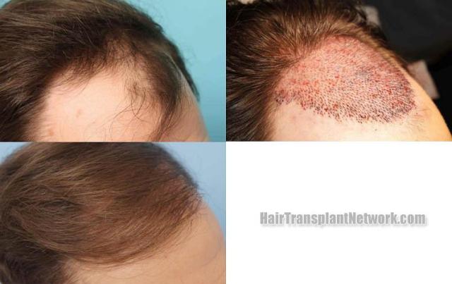 Hair transplantation surgery before and after images