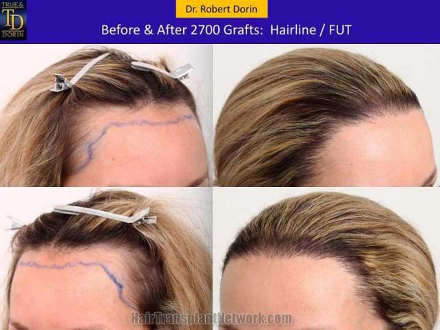 Hair transplantation surgery before and after pictures