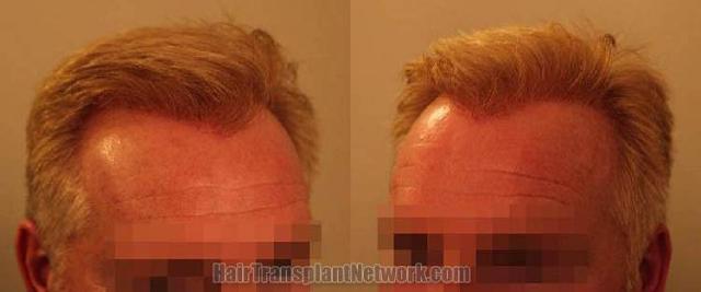 Hair transplantation procedure before and after 