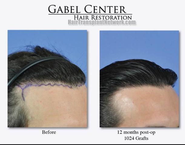 Hair transplant surgery before and after images