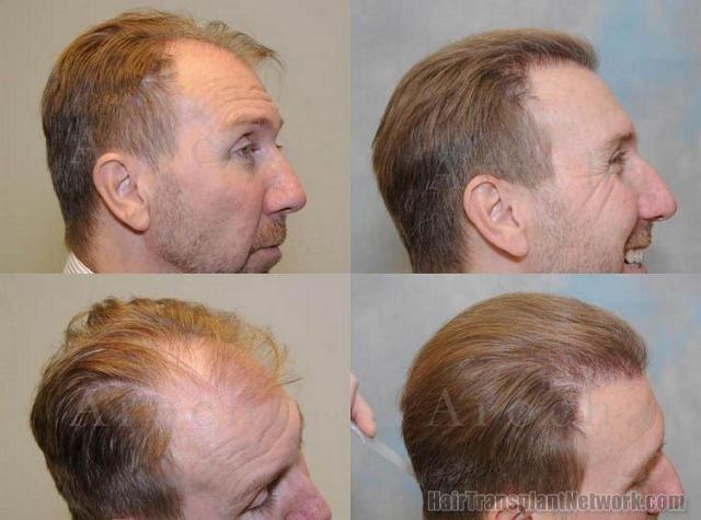 Right side views - showing before and after results from hair transplant