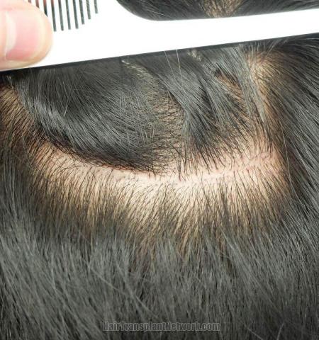 Hair transplant surgery before and after pictures