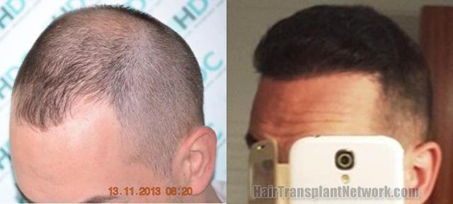 Hair transplantation surgery before and after images