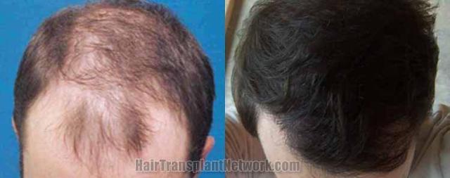 Hair replacement surgery before and after images