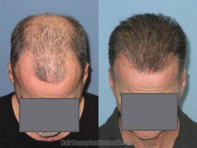 Hair restoration surgery before and after images