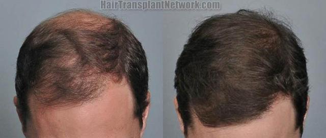 Hair transplantation surgery before and after pictures