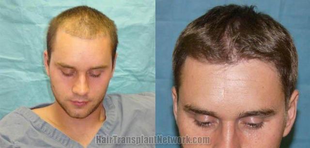 Tilt down view - before and postoperative hair transplant