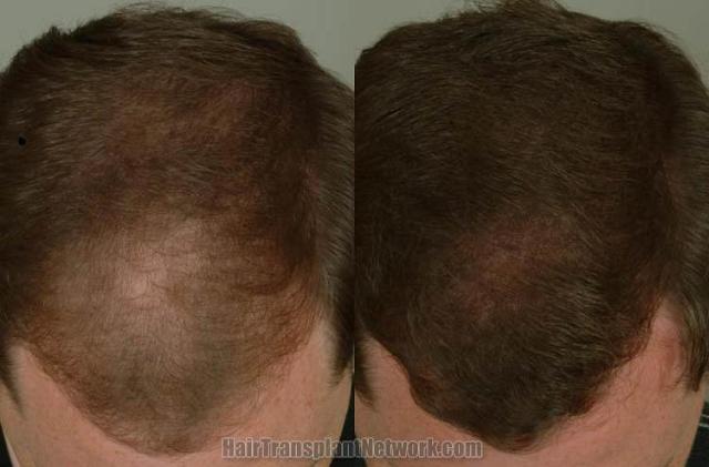 Hair transplantation surgery before and after pictures