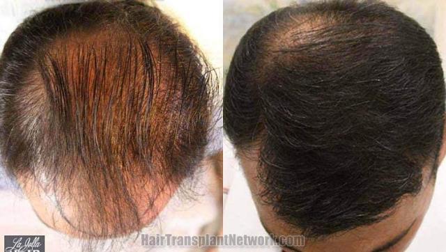 Before and after hair transplant procedure images