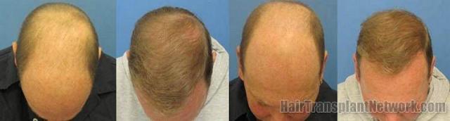  results from 4365 grafts