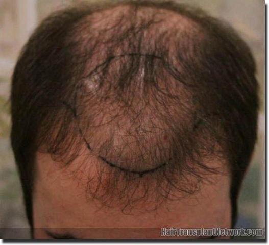 Hair restoration procedure results