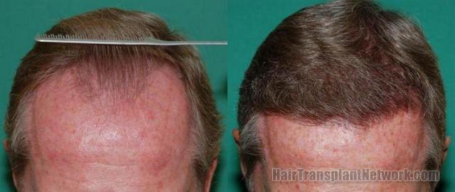 Hair Restoration before and after photo