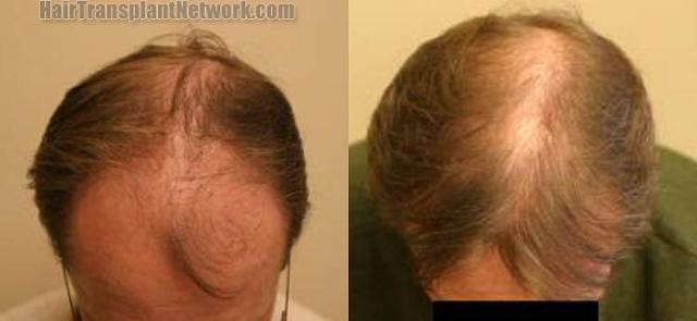 Top view before and after hair restoration results