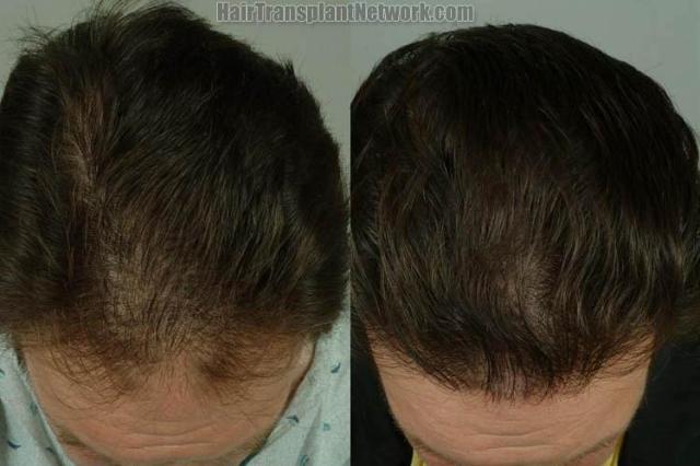 Hair restoration procedure before and after results