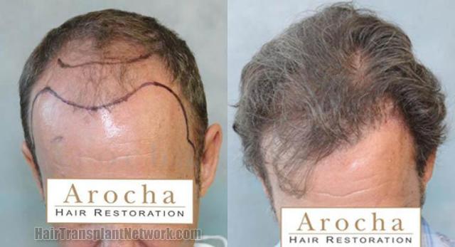 Hair restoration procedure before and after results