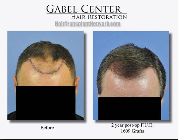 Hair restoration procedure before and after results