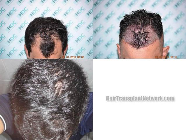 Hair transplantation surgery before and after photos