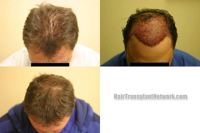 Hair transplantation surgery before and after photos