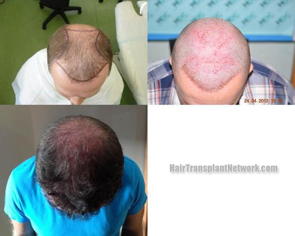 Hair transplantation surgery before and after images