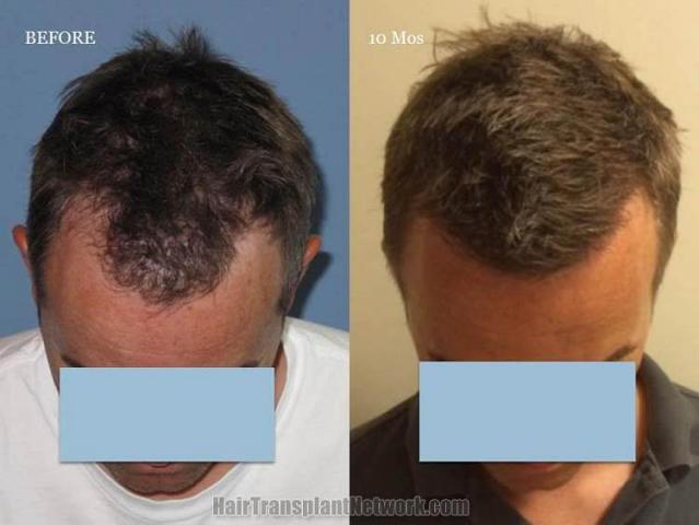 Hair transplantation surgery before and after photos