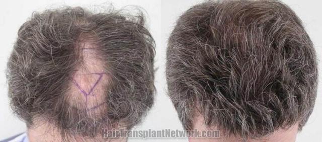 Top view before and after hair restoration results