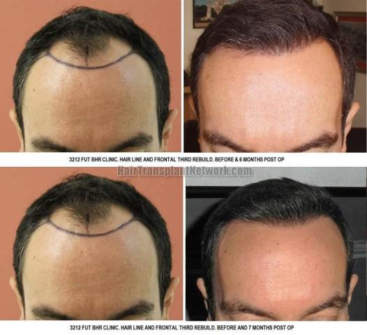 Hair transplantation surgery before and after images