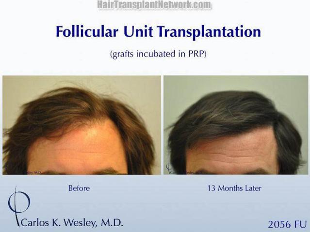 Hair restoration procedure before and after results